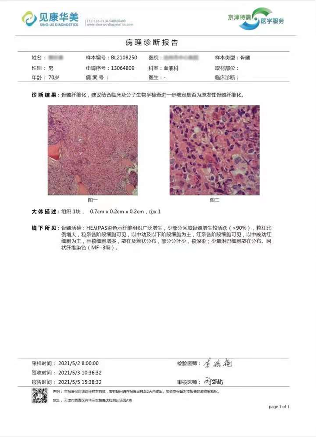 大咖谈病例｜景红梅教授点评-原发性骨髓纤维化（PMF）诊疗方法之病例解析