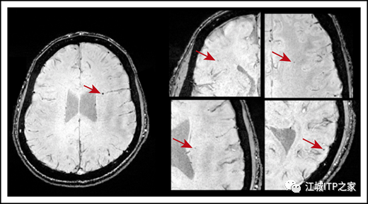 科普时间 | ITP患者，隐匿性脑微出血，关注还是忽略？-ITP家园