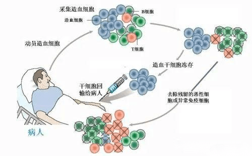 怎么治疗进展期MPN