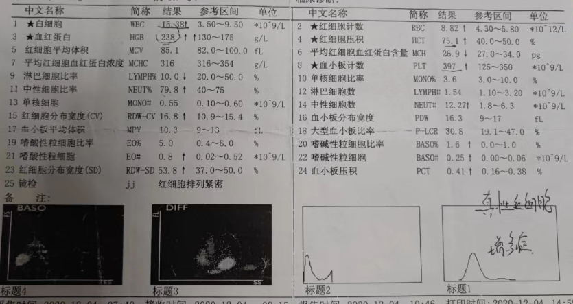 大咖谈病例 | 张敬宇教授：一例真性红细胞增多症的病例点评